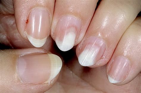 отходит ноготь под гель лаком что делать