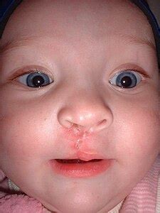 Cleft lip and cleft palate - Wikipedia