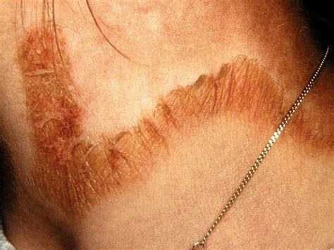 Pellagra: Definition, symptoms, pictures, and more