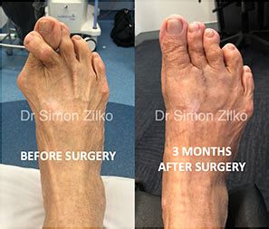1st MTP Joint Fusion Perth | Dr Simon Zilko | Big Toe Joint Fusion ...