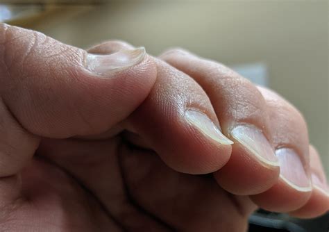 Nail dystrophy and koilonychia: a little known cause : nursepractitioner
