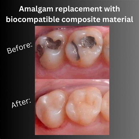 Safe Amalgam Removal at Apex Dental