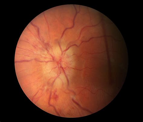 Moran CORE | Case Report of Vision Threatening Papilledema due to