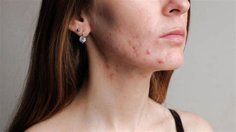 candida acne  bacterial acne key differences