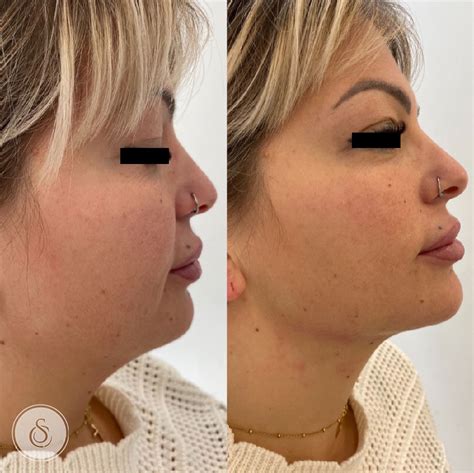 HIFU experiences and before and after photos | Sarasin Clinic