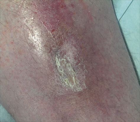 Adalimumab Treatment for Pyoderma Gangrenosum | Dermatology | JAMA ...