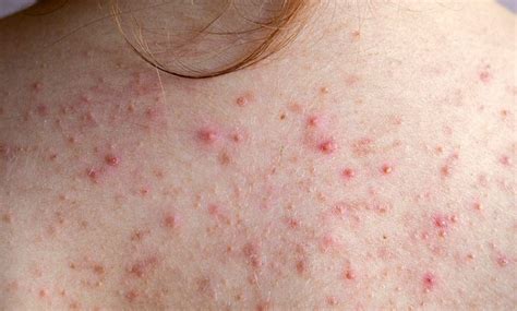 acne bacne types symptoms   vitastem ultra