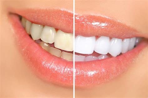 teeth whitening cost    benefits