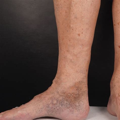 The Skin is Affected by Bad Leg Veins | The VeinCare Centre