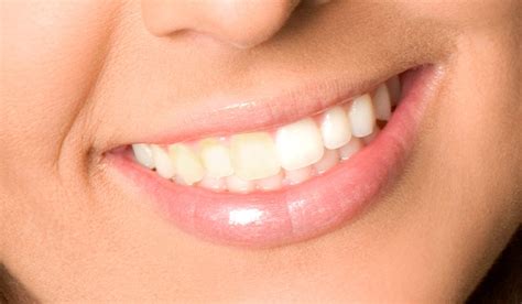 Understanding Teeth Stains: Causes and Tips for Prevention