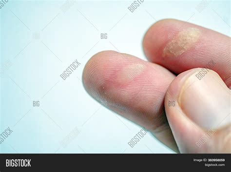 Burnt Fingers, Finger Image & Photo (Free Trial) | Bigstock