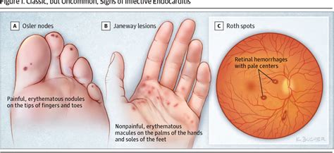 infective endocarditis cartoon