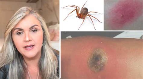 Picada De Aranha Marrom - Picada Precoce De Aranha Reclusa Marrom Vídeo: Dentista De Juiz De