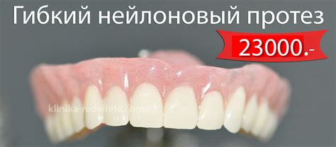 Мягкие нейлоновые протезы в Твери: цена установки 2000 ₽ в стоматологии ...