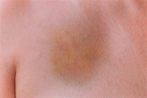What Colour Covers Yellow Bruise at Carlos Snyder blog