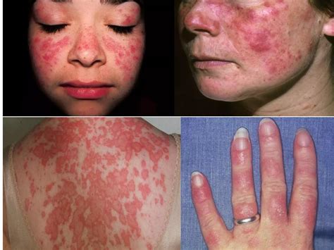 systemic lupus erythematosus sle pptx