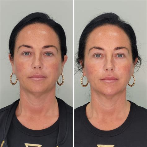 Non Surgical Facelift Treatment for Models - Cosmetic Courses