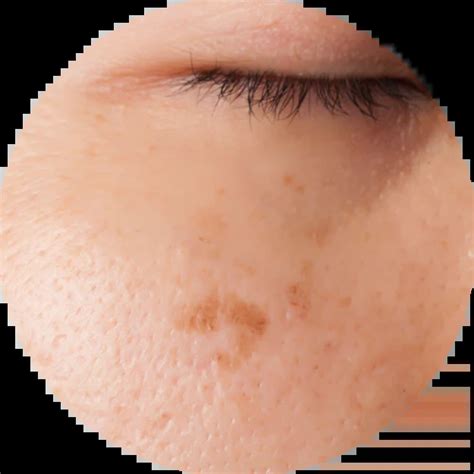 facial muka chemical peel  narqes  parut hitam