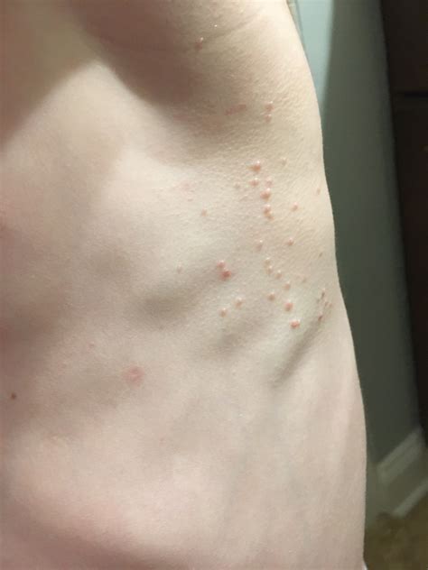Molluscum Contagiosum What Is Molluscum Contagiosum Symptoms Signs ...