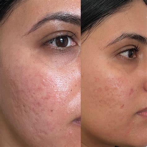 Unblemished Stop Breakouts Fight Acne Transform Yo 5