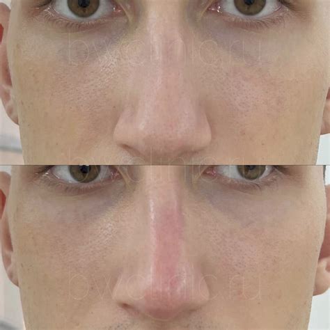 Ботокс лица для мужчин: цены в Москве | Стоимость инъекций Botox для ...