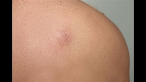 Kirurgija ateroma / Atheroma Surgery - YouTube