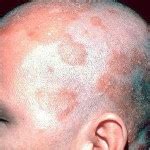 Лечение травами - народные рецепты: Себорея (себорейный дерматит ...