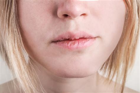 9 motivi per cui le labbra si screpolano | DonnaD