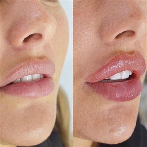 Увеличение губ | Cirugias de nariz, Tipo de labios, Relleno de labios