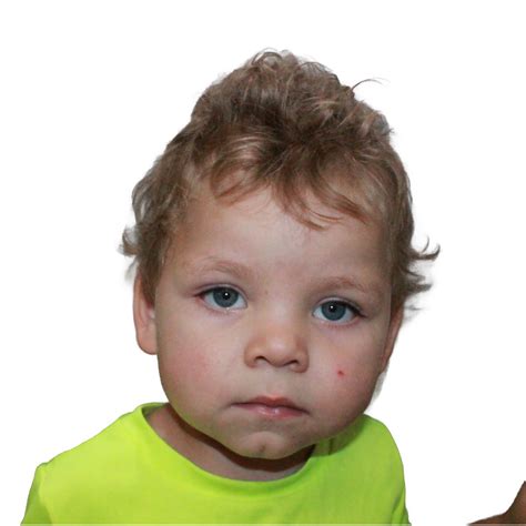 Endoscopic Strip Crani with Helmeting - Kansas Cleft and Craniofacial