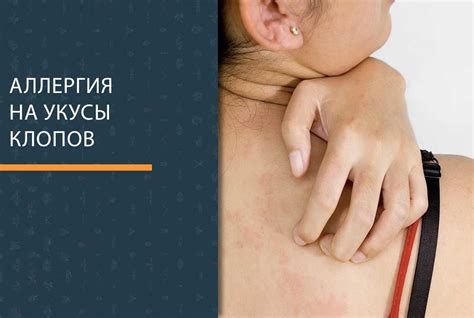 АЛЛЕРГИЯ на укусы клопов – симптомы у детей и взрослых