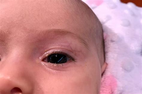 identification  treatment  pink eye  babies  eye news