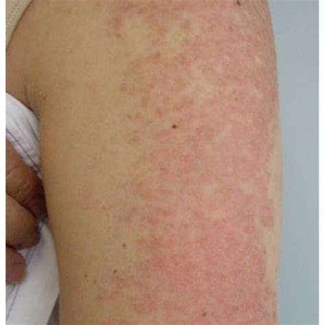 (PDF) Cutaneous lupus Erythematosus: A review of the literature ...