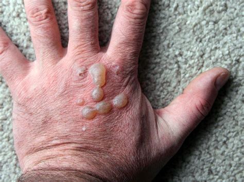 Why Do I Have Painful Bumps On My Hands at Melissa Dunphy blog