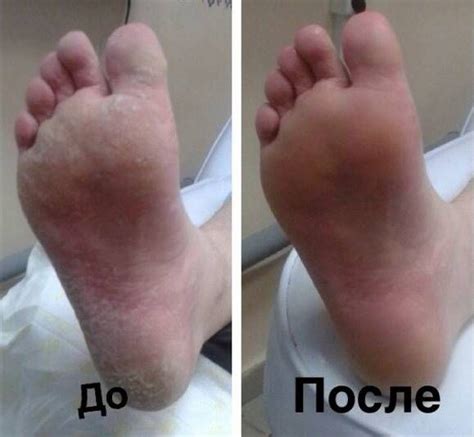 Педикюр мужской: до и после — Modnail.ru — Красивый маникюр