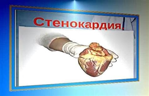 Симптомы стенокардии что делать - крик нашего сердца