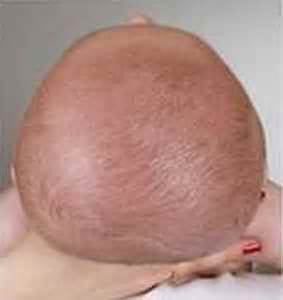 Brachycephaly - MedFriendly.com