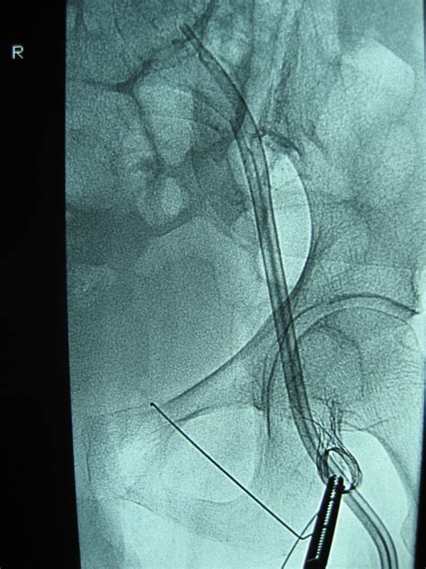 Stent pulled back in Common Femoral vein. | Download Scientific Diagram