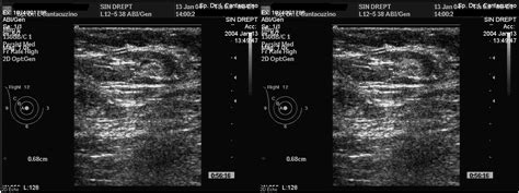 Ultrasound Axillary Imaging | IntechOpen