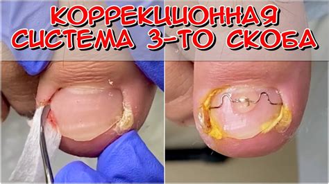 Последствия вросшего ногтя на ноге фото