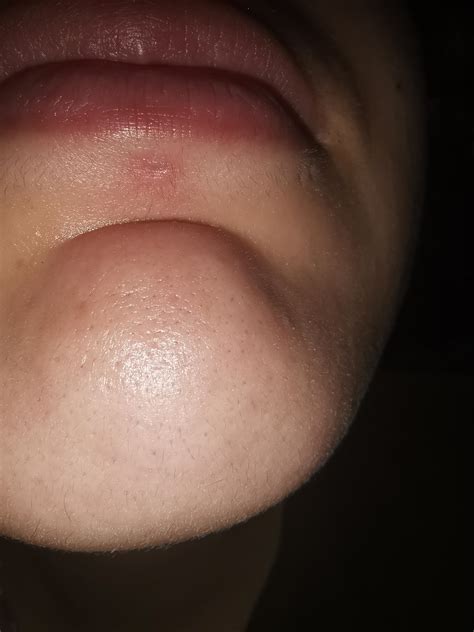 Raised bump on closed piercing hole : r/piercinghelp
