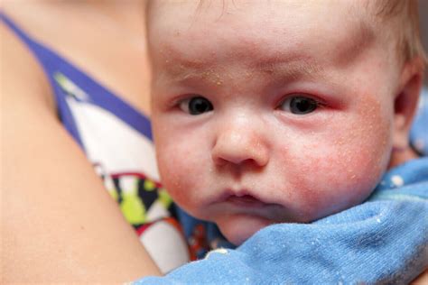 Top 10 Tips to Help Treat Baby Eczema - Happy Skin, PLLC