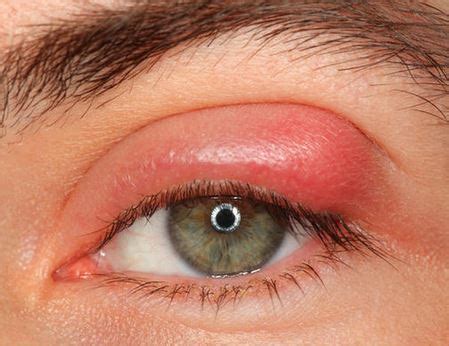 swollen eyelid home remedies cure upper   swollen eyelids