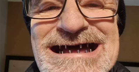 Man has new £7,000 Turkey Teeth after years of smoking killed his old ...
