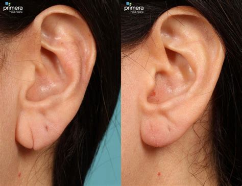 cosmetic ear surgery ear surgery procedure steps ssmsr