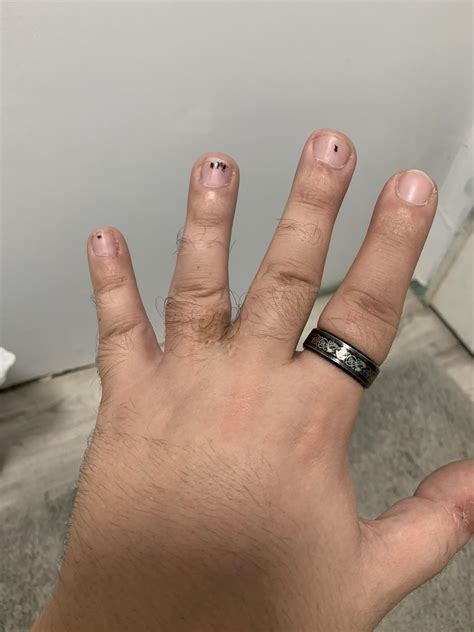 Since someone posted their webbed fingers, I had the same thing but it