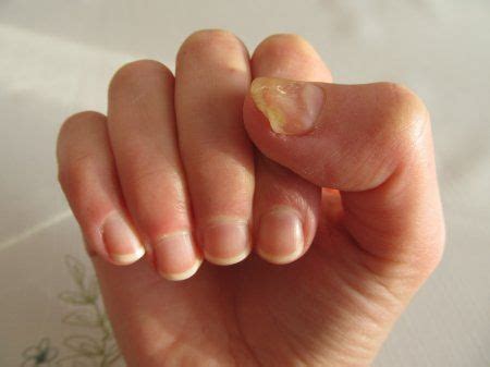 Nail fungus | clinic Altimed