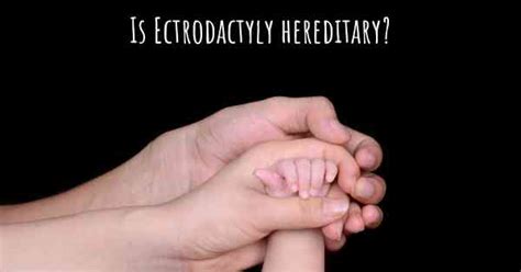 ectrodactyly hereditary