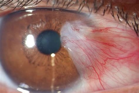 benh mong thit nguyen nhan bien chung va cach dieu tri