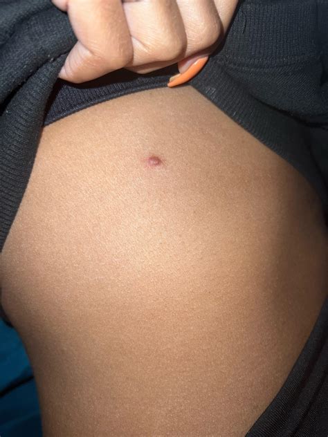 Right side rib cage. Has been here for a week. What is this ? : r